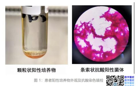 [病例交流] Xpert MTB/RIF 实现结核分枝杆菌的鉴别诊断