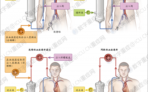NEJM：急性肾损伤的体外肾脏替代疗法