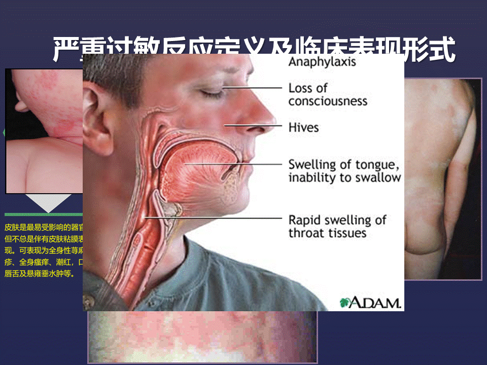 严重过敏反应急救的理论与实践