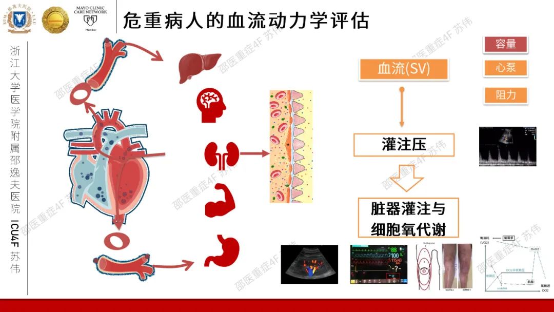 血流动力学系列-肺动脉楔压(PAWP)