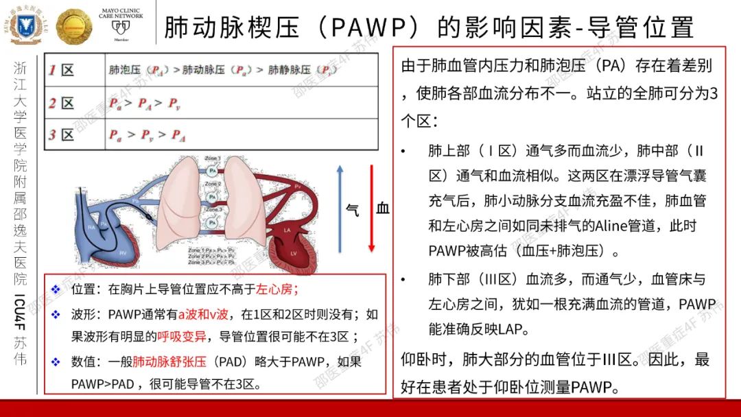 血流动力学系列-肺动脉楔压(PAWP)