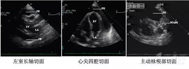 进阶必备：超声心动图报告单解读（常见疾病篇）