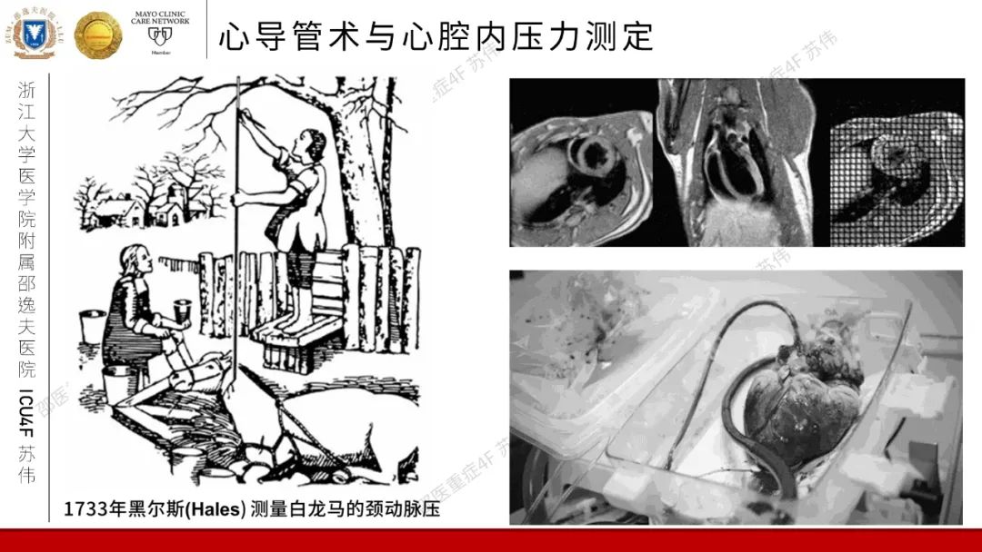 血流动力学系列-肺动脉楔压(PAWP)