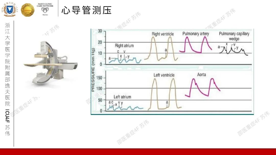血流动力学系列-肺动脉楔压(PAWP)