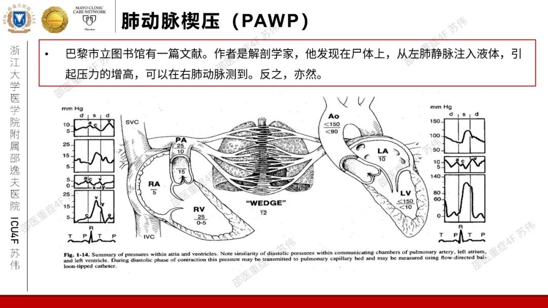 血流动力学系列-肺动脉楔压(PAWP)