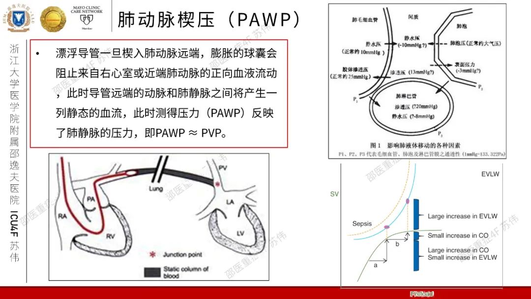 血流动力学系列-肺动脉楔压(PAWP)