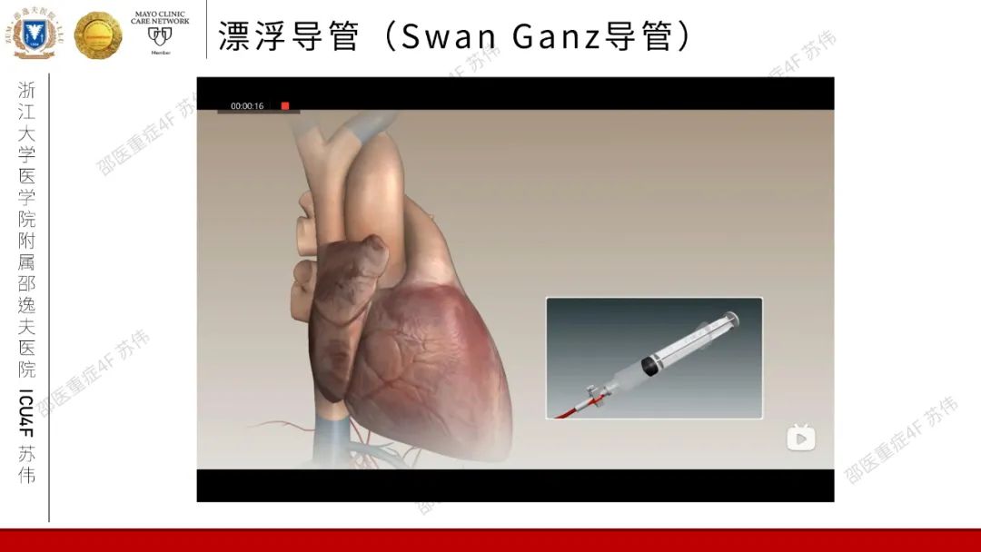 血流动力学系列-肺动脉楔压(PAWP)