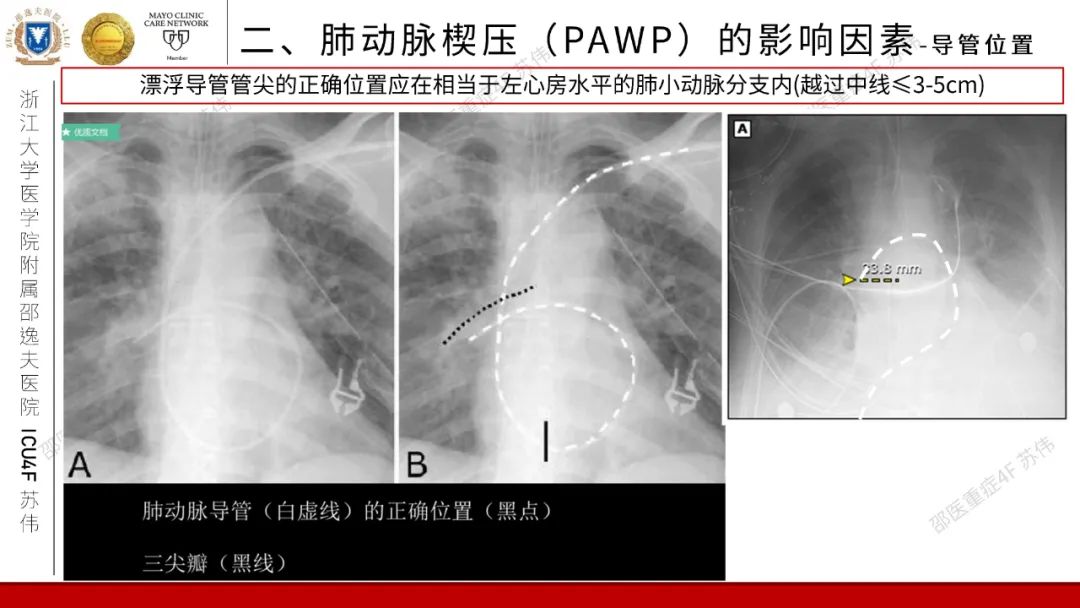 血流动力学系列-肺动脉楔压(PAWP)