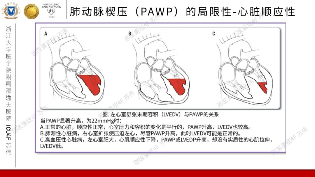 血流动力学系列-肺动脉楔压(PAWP)