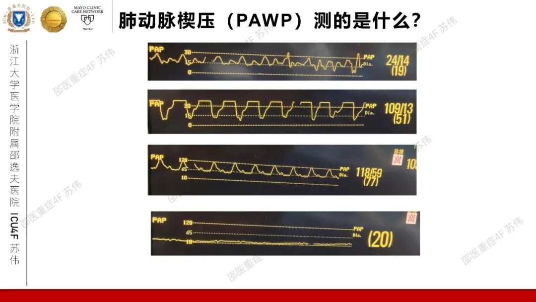 血流动力学系列-肺动脉楔压(PAWP)