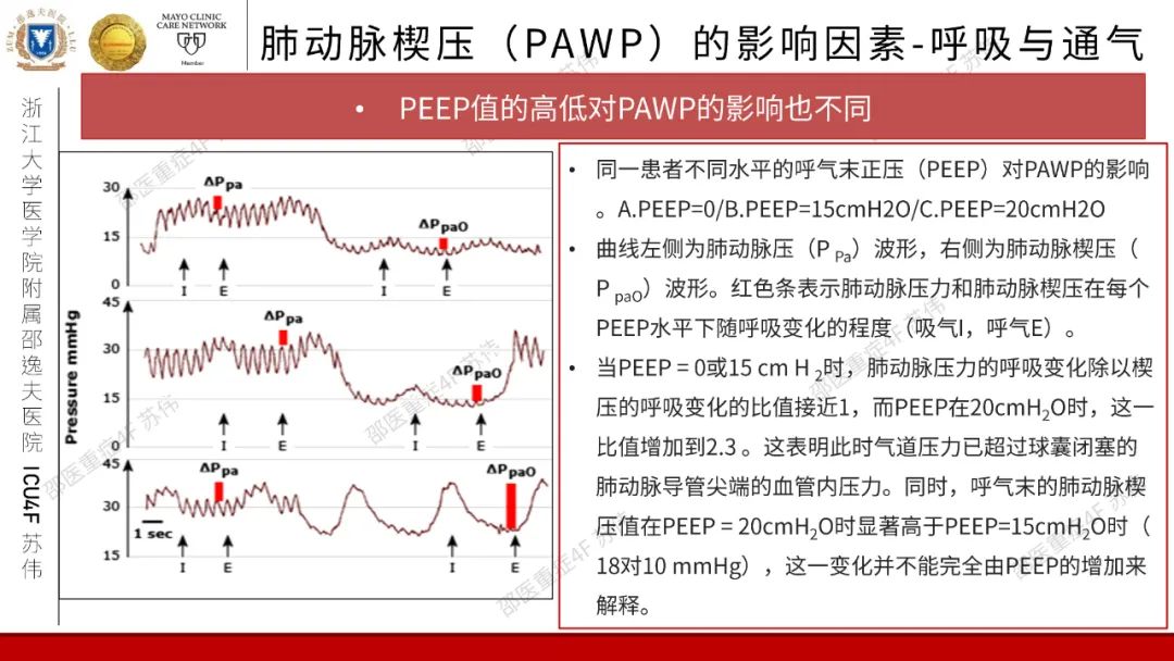 血流动力学系列-肺动脉楔压(PAWP)