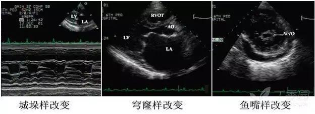 进阶必备：超声心动图报告单解读（常见疾病篇）