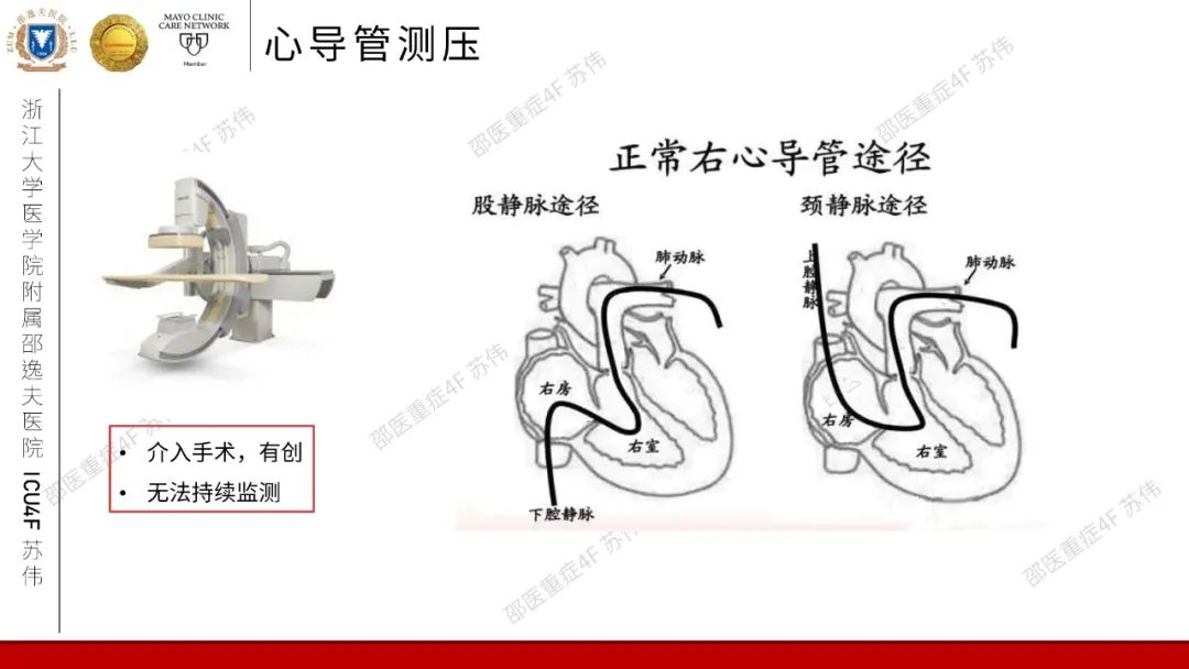 血流动力学系列-肺动脉楔压(PAWP)