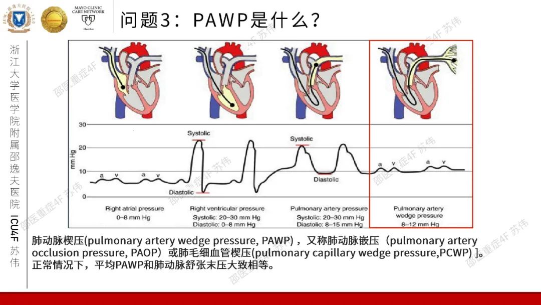 血流动力学系列-肺动脉楔压(PAWP)