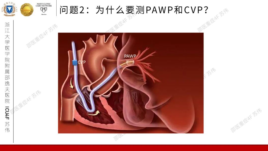 血流动力学系列-肺动脉楔压(PAWP)