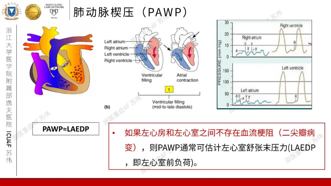 血流动力学系列-肺动脉楔压(PAWP)