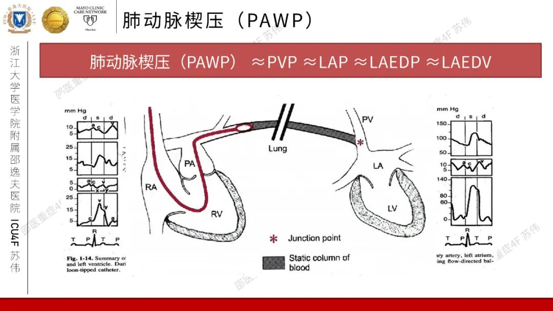 血流动力学系列-肺动脉楔压(PAWP)