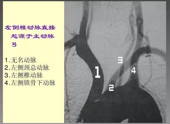 神内影像丨脑血管造影图片详解 神内影像丨脑血管造影图片详解