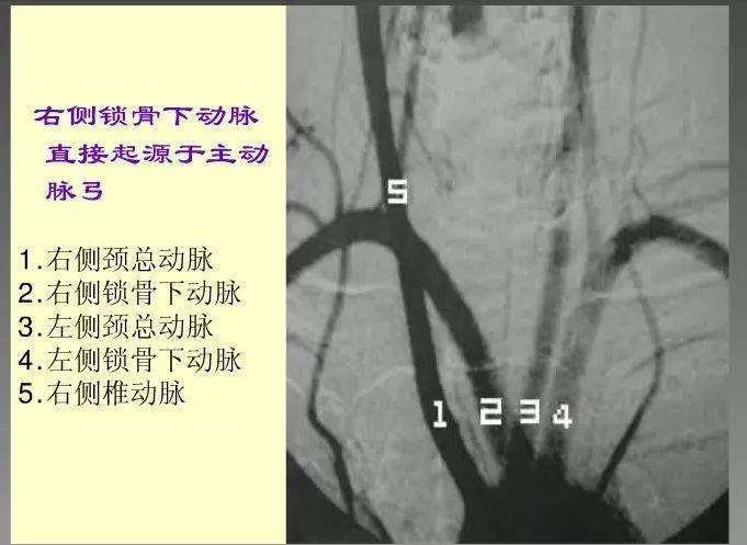 神内影像丨脑血管造影图片详解 神内影像丨脑血管造影图片详解