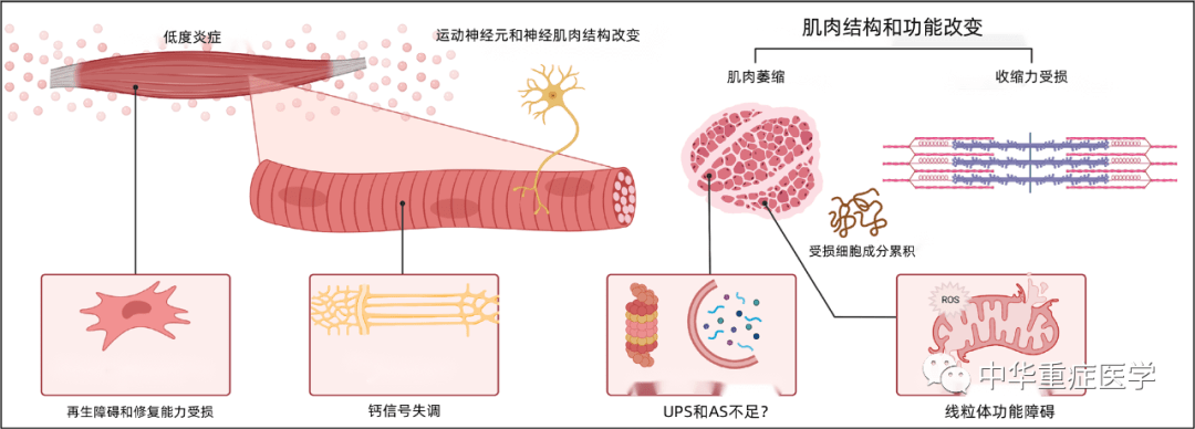 慢性危重症和重症监护后综合征：从病理生理学到临床挑战