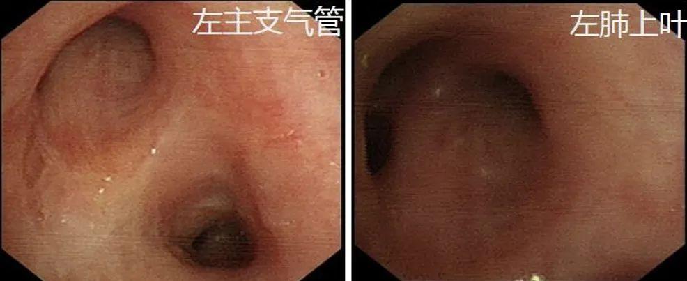 女青年无任何基础病,何因急发高热、呼吸困难?这种难治性或进展性IPA治疗从何入手?丨疑案探密(125) 女青年无任何基础病,何因急发高热、呼吸困难?这种难治性或进展性IPA治疗从何入手?丨疑案探密(125)