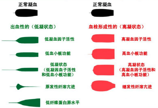 轻松读懂血栓弹力图 轻松读懂血栓弹力图