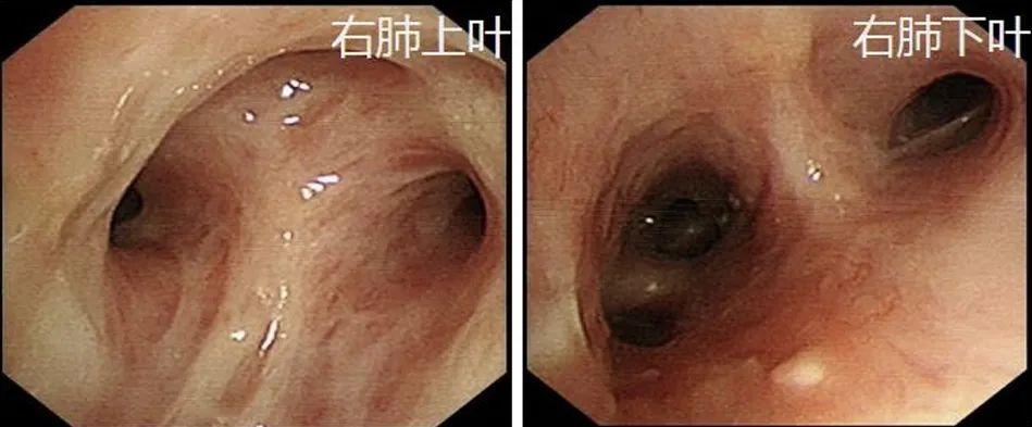 女青年无任何基础病,何因急发高热、呼吸困难?这种难治性或进展性IPA治疗从何入手?丨疑案探密(125) 女青年无任何基础病,何因急发高热、呼吸困难?这种难治性或进展性IPA治疗从何入手?丨疑案探密(125)