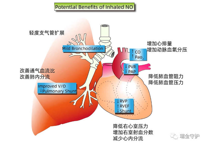 一氧化氮吸入治疗技术 一氧化氮吸入治疗技术