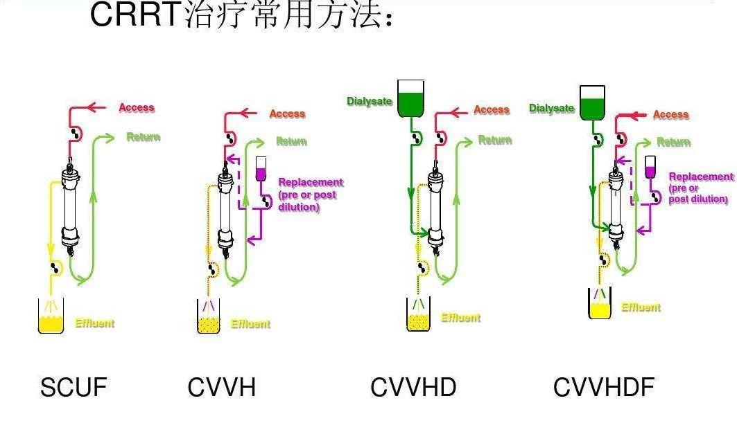 四步学会 CRRT 的规范化治疗流程