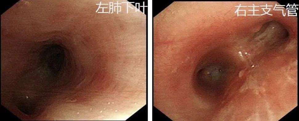 女青年无任何基础病,何因急发高热、呼吸困难?这种难治性或进展性IPA治疗从何入手?丨疑案探密(125) 女青年无任何基础病,何因急发高热、呼吸困难?这种难治性或进展性IPA治疗从何入手?丨疑案探密(125)