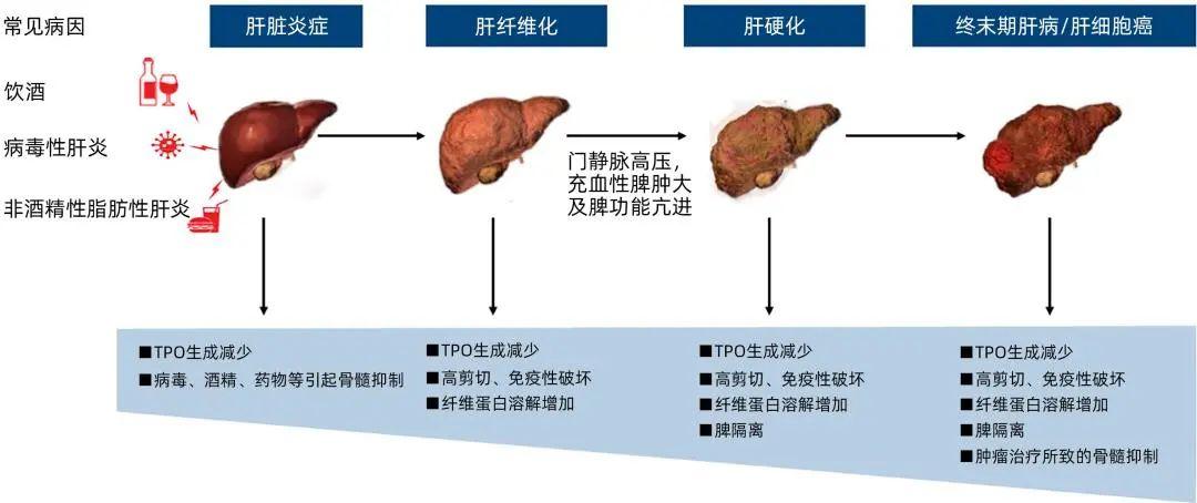 权威发布｜肝病相关血小板减少症临床管理中国专家共识