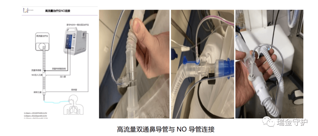 一氧化氮吸入治疗技术 一氧化氮吸入治疗技术