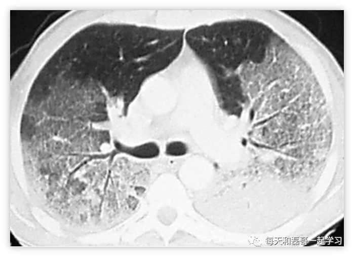 重症疾病之急性呼吸窘迫综合征（二）-ARDS的流行病学及临床特征