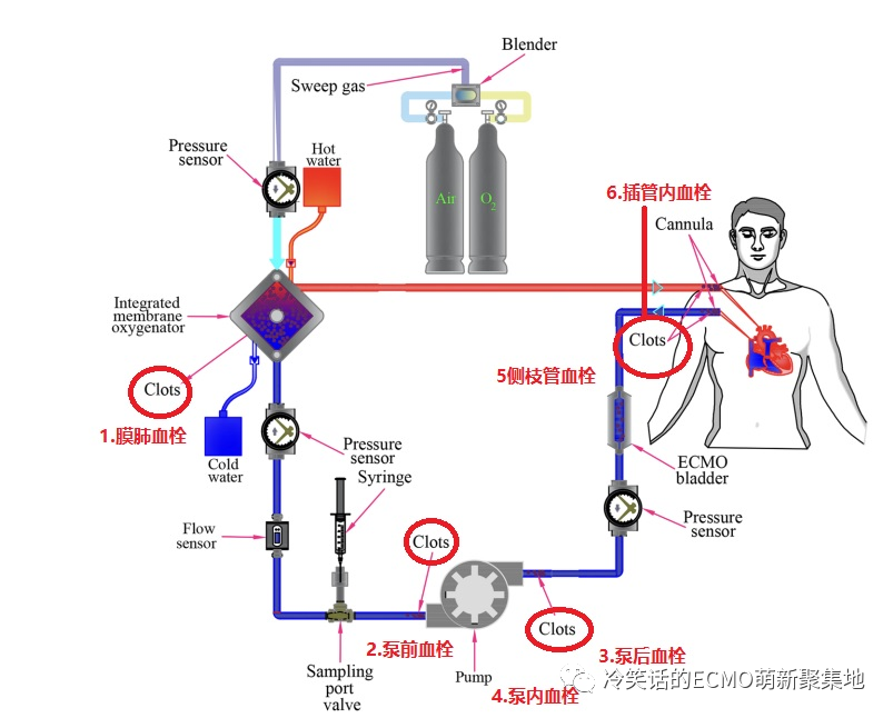 ECMO抗凝-每天半小时轻松学会独立管理ECMO ECMO抗凝-每天半小时轻松学会独立管理ECMO