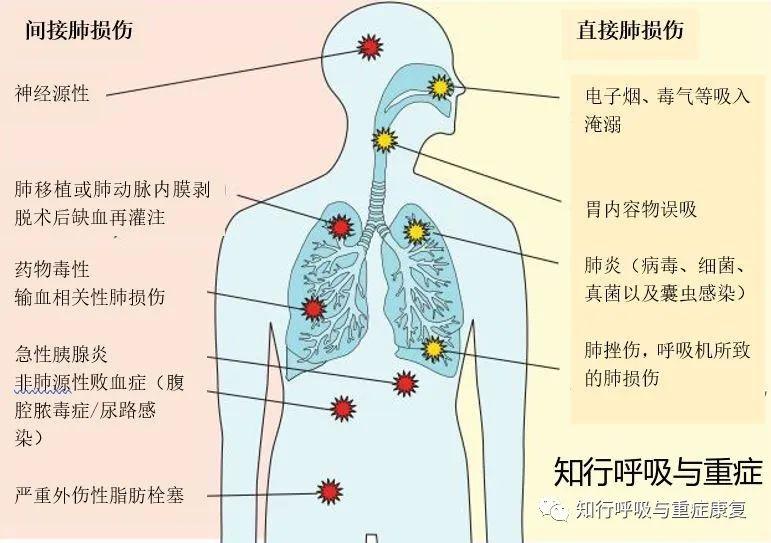 ARDS的诊断、病理生理学及治疗策略