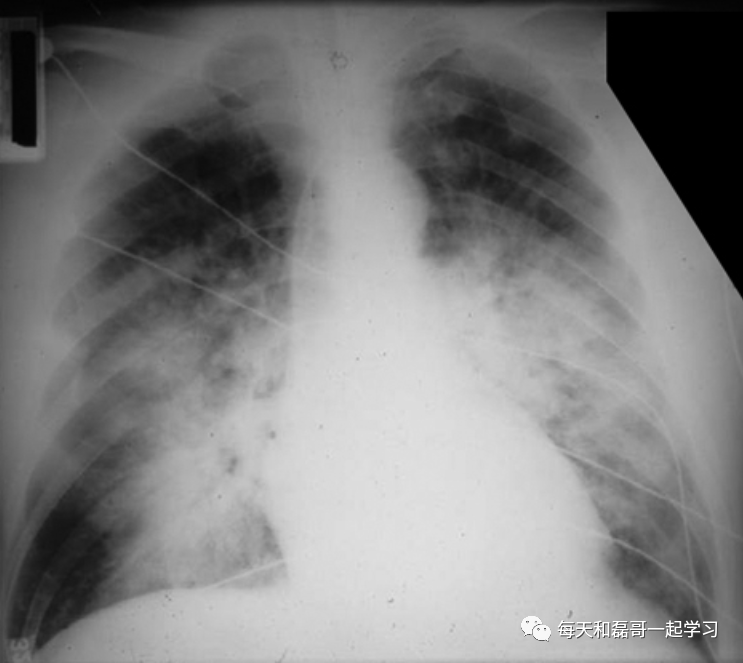 重症疾病之急性呼吸窘迫综合征（二）-ARDS的流行病学及临床特征