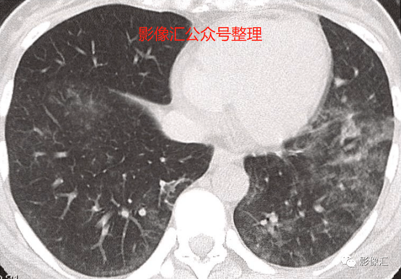 急性呼吸窘迫综合征(ARDS)病因 、病理、分期及影像表现 急性呼吸窘迫综合征(ARDS)病因 、病理、分期及影像表现