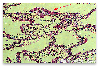 重症疾病之急性呼吸窘迫综合征（八）-ARDS的病理生理学