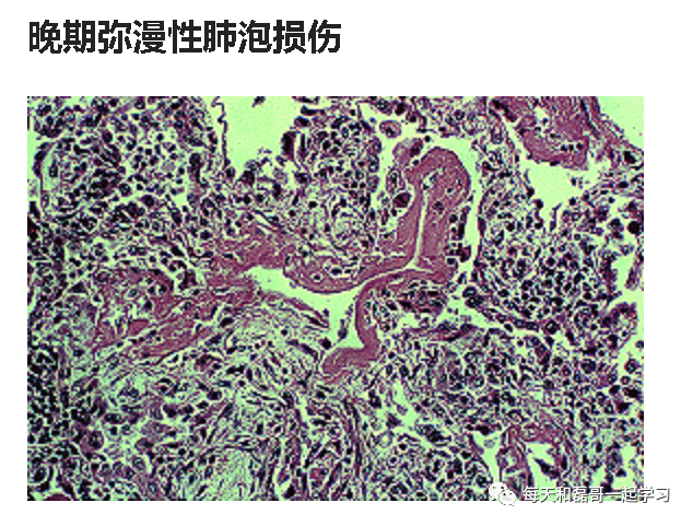 重症疾病之急性呼吸窘迫综合征(一)-ARDS的诊断 重症疾病之急性呼吸窘迫综合征(一)-ARDS的诊断