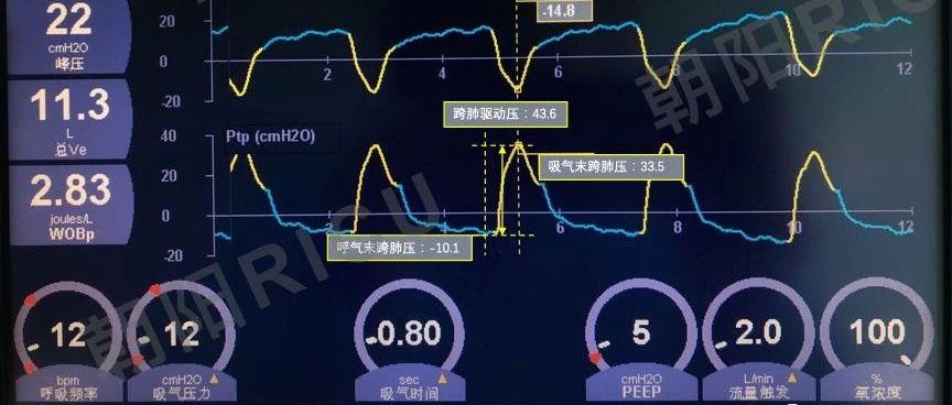 模式相关知识--跨肺压和驱动压