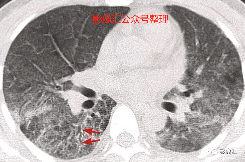 急性呼吸窘迫综合征(ARDS)病因 、病理、分期及影像表现 急性呼吸窘迫综合征(ARDS)病因 、病理、分期及影像表现
