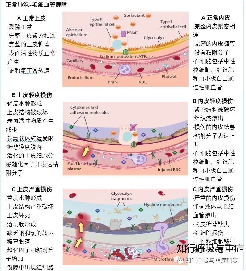 ARDS的诊断、病理生理学及治疗策略