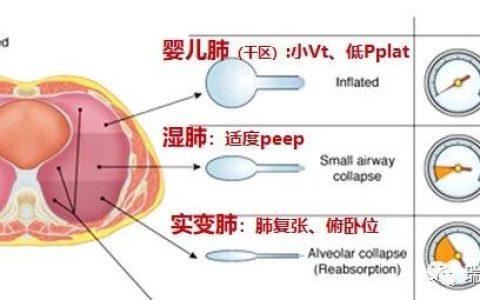 机械通气误区：ARDS患者肺顺应性下降