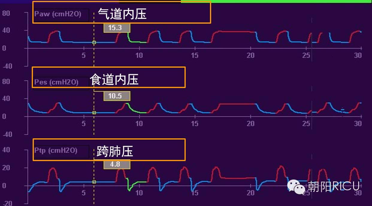 教你认识跨肺压
