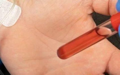 血栓弹力图技术在低分子肝素治疗监测中的临床应用价值