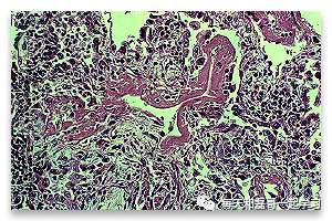 重症疾病之急性呼吸窘迫综合征（八）-ARDS的病理生理学