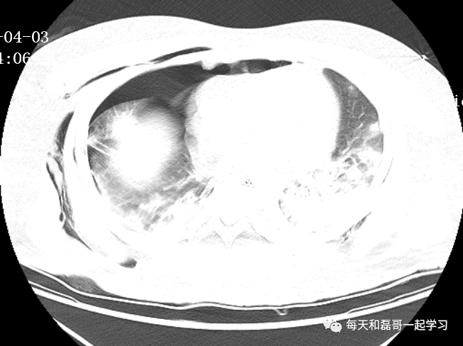 重症疾病之急性呼吸窘迫综合征(三)-ARDS的病因及诱发因素 重症疾病之急性呼吸窘迫综合征(三)-ARDS的病因及诱发因素