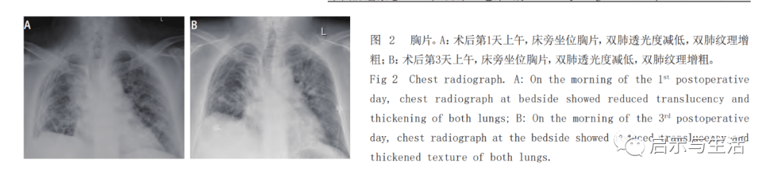 肺癌术后特发性肺纤维化急性加重抢救成功病例报道