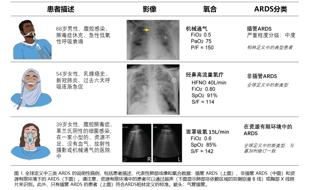 第144期《临床那些事儿》：ARDS——从共识到定义