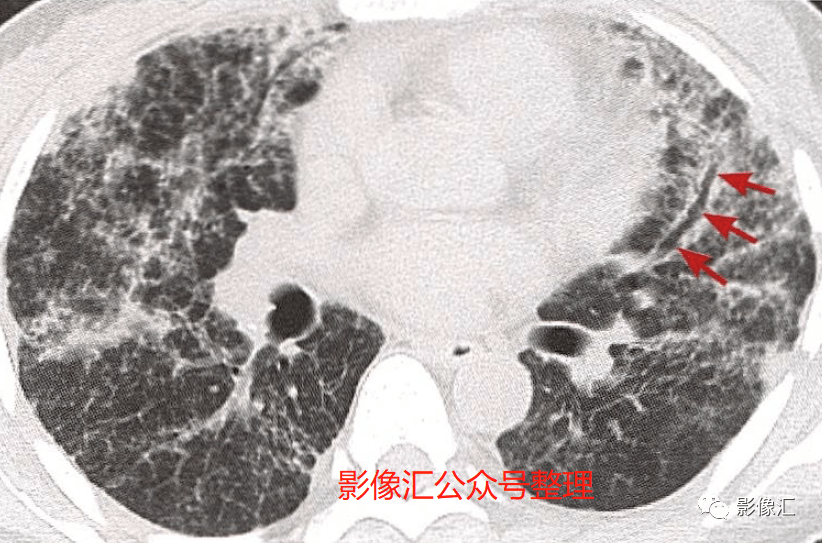 急性呼吸窘迫综合征(ARDS)病因 、病理、分期及影像表现 急性呼吸窘迫综合征(ARDS)病因 、病理、分期及影像表现